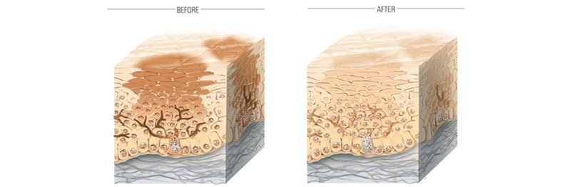 Viên uống Sakura HCL dưỡng trắng trị nám hiệu quả từ sâu trong tế bào da