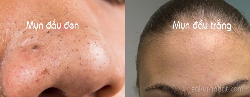 Các loại mụn thường gặp ở lứa tuổi dậy thì 1