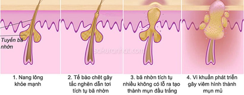 Các loại mụn thường gặp ở lứa tuổi dậy thì 2