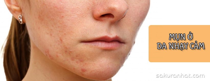 Nguyên tắc trị mụn cám cho làn da nhạy cảm