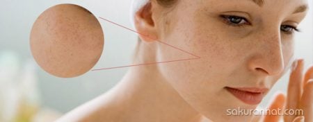 Tại sao trị nám da mặt cần phải tuân thủ theo liệu trình?