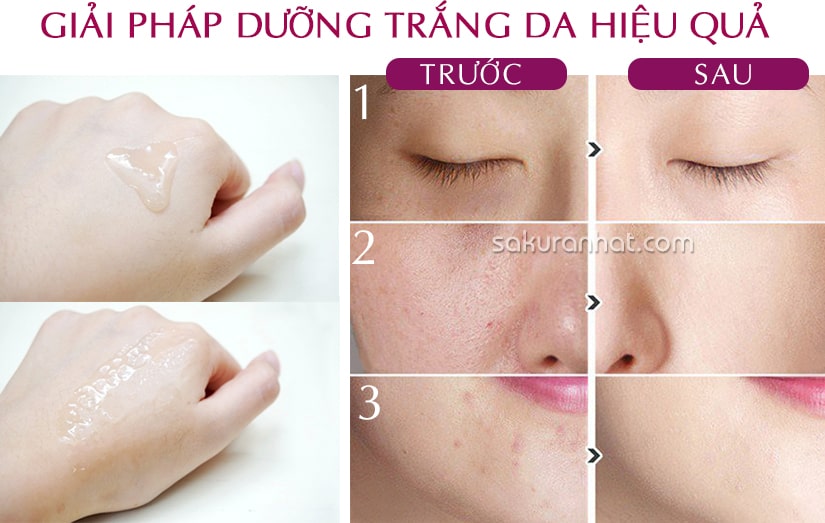 Trước và sau khi dùng Serum trị nám Sakura